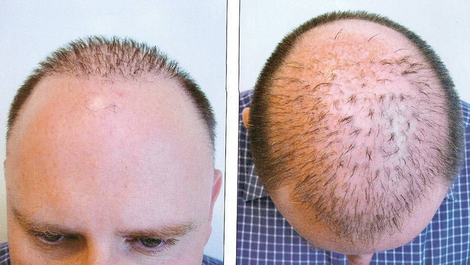 Dr.Madhu:::Hair Transplant Surgeon, India- Hyderabad::: for best ...