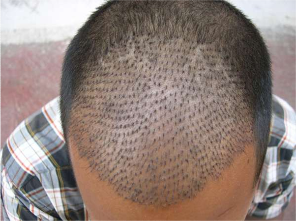 Dr.Madhu:::Hair Transplant Surgeon, India- Hyderabad::: for best ...