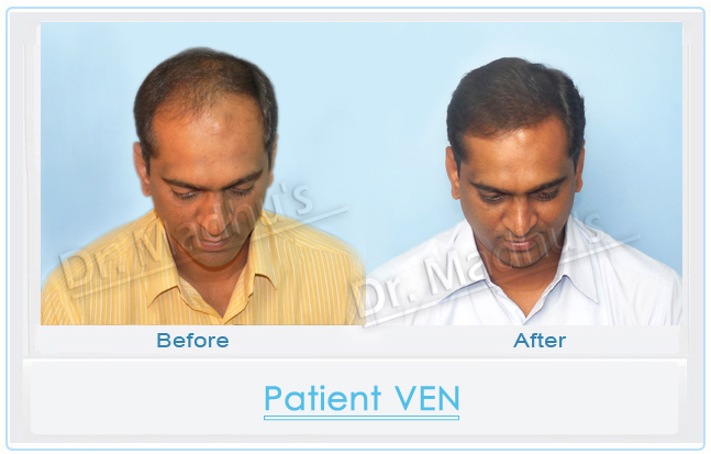 images-hair-transplant