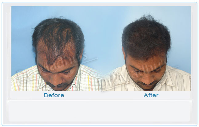 images-hair-transplant