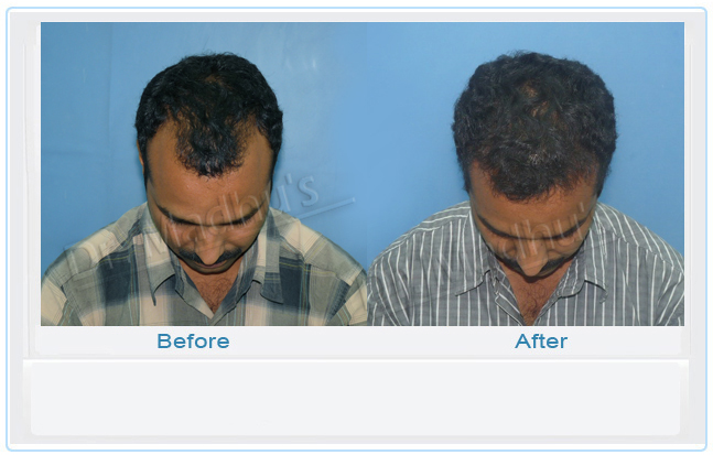 images-hair-transplant