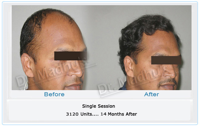 images-hair-transplant-chennai