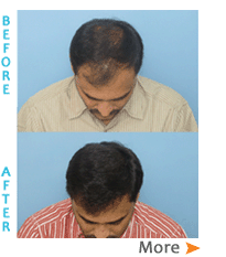 Hair doctors in Hyderabad  Best Hair Transplant Surgeon in Hyderabad